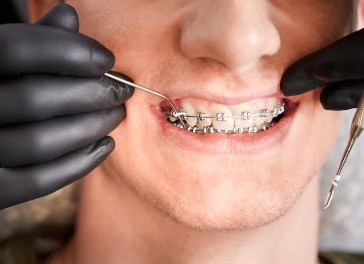 Are clear aligners a better choice than metal appliances