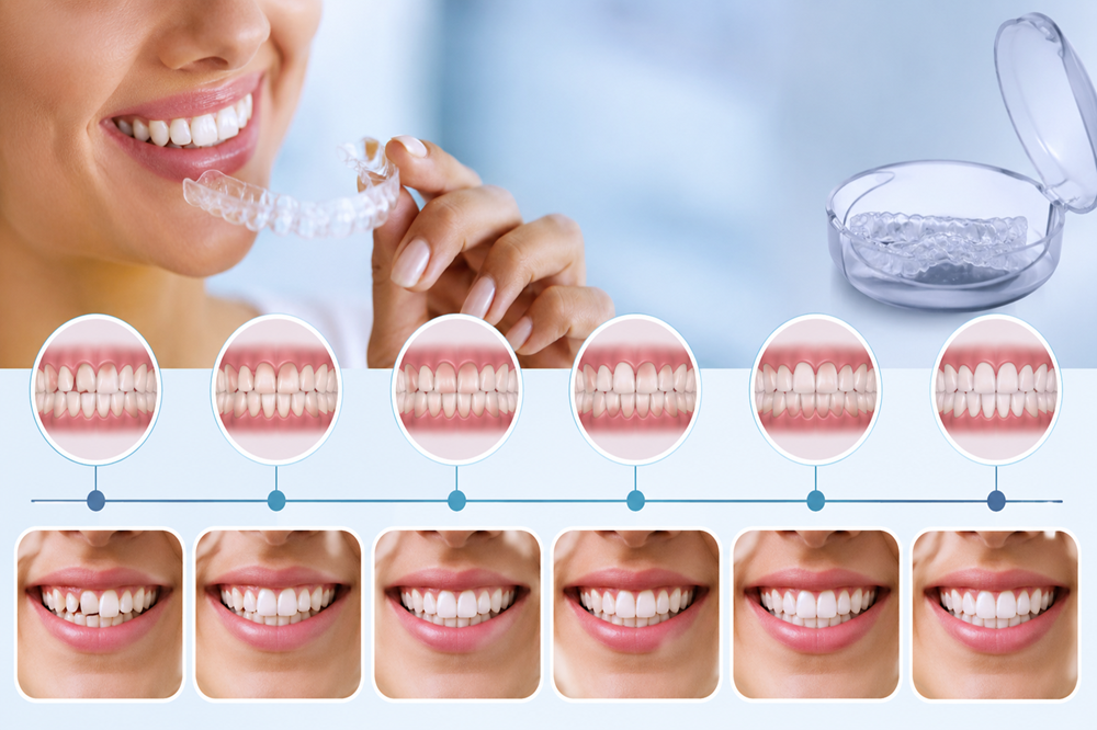 Invisalign Results What You Can Expect Month by Month